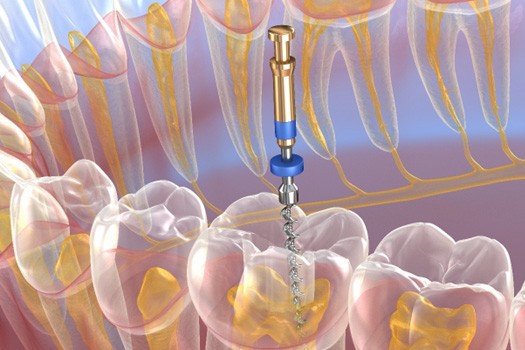 We provide stress free endodontic retreatment near River Edge