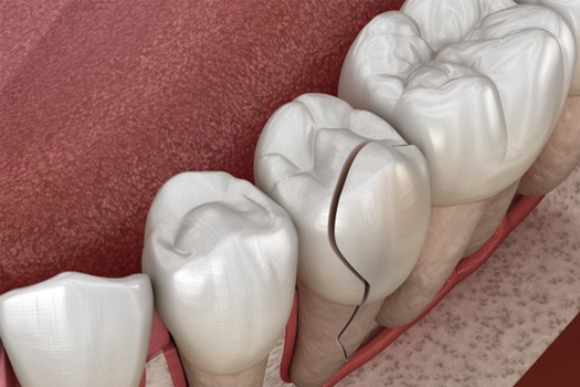 Repair cracked teeth near River Edge