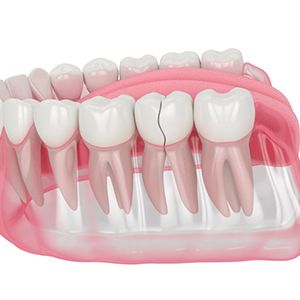 Digital image of a crack splitting a tooth in half